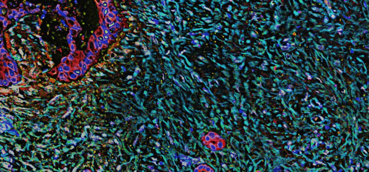 AI speeds up cancer drug development